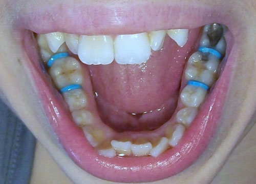 Trường hợp răng mọc lệch lạc nhiều thường được chỉ định đặt thun tách kẽ