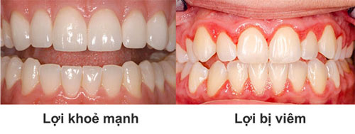 Viêm nướu răng là bệnh răng miệng khá phổ biến