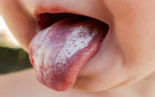 Bề mặt lưỡi của trẻ xuất hiện nhiều mảng trắng