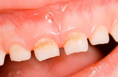 Bề mặt răng bị xỉn màu là dấu hiệu nhận biết của tình trạng mòn răng ở trẻ