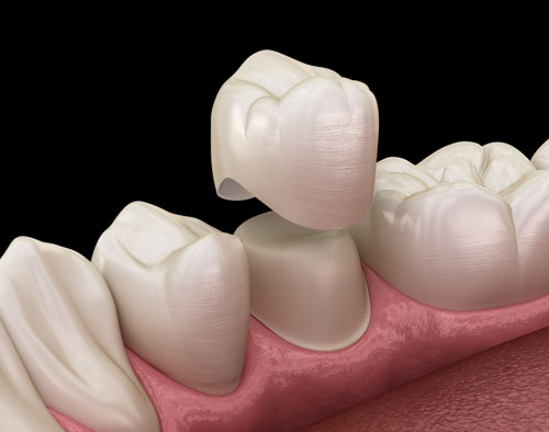 Bọc răng sứ cho những chiếc răng đã chữa tủy sẽ giúp duy trì tuổi thọ được lâu hơn
