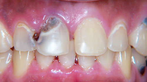 Cần điều trị triệt để tình trạng răng sâu mới có thể thực hiện niềng răng được