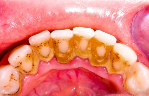Cao răng là những mảng bám màu vàng nhạt bám cứng chắc trên bề mặt răng