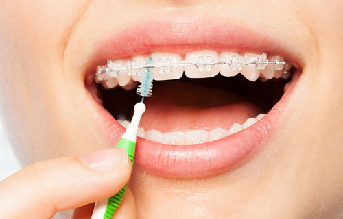 Chải răng sạch sẽ sau mỗi bữa ăn giúp ngăn ngừa hôi miệng, sâu răng