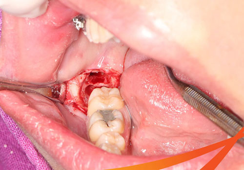 Chảy máu kéo dài là một biến chứng thường gặp sau nhổ răng khôn