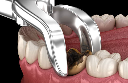 Chỉ định nhổ răng trong trường hợp chiếc răng hư hỏng không thể điều trị bảo tồn
