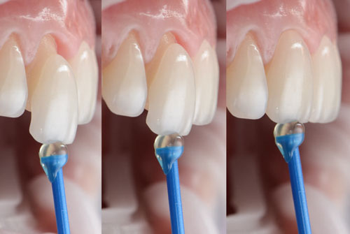 Dán răng sứ hạn chế tối đa tỷ lệ mài răng