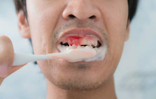 Đánh răng sai cách dễ làm tổn thương đến răng nướu