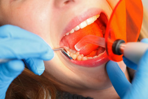 Hàn trám răng với những trường hợp răng sâu nhẹ