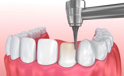 Mài răng là bước điều chỉnh lại hình dáng và phương hướng của răng