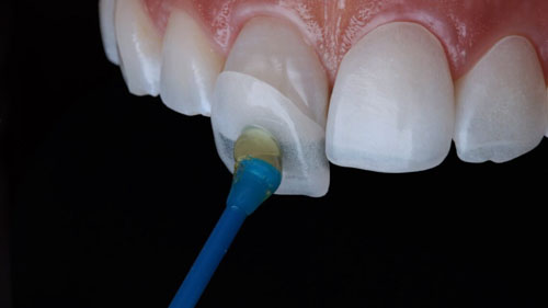 Mặt dán sứ có tỷ lệ mài răng tương đối thấp