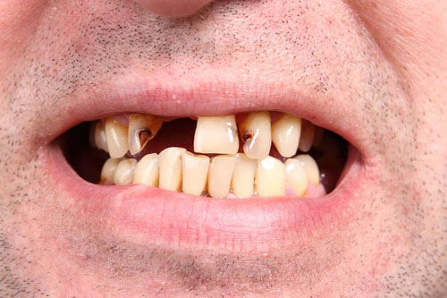 Mất răng có thể do nhiều nguyên nhân gây nên
