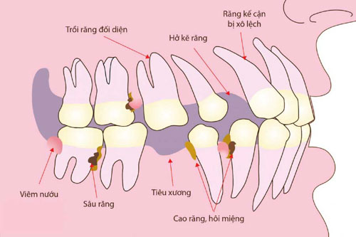 Mất răng gây hàng loạt vấn đề nghiêm trọng khác