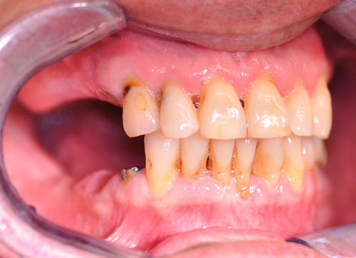 Mất răng hàm trên bị tiêu xương hàm nhiều có thể cần nâng xoang