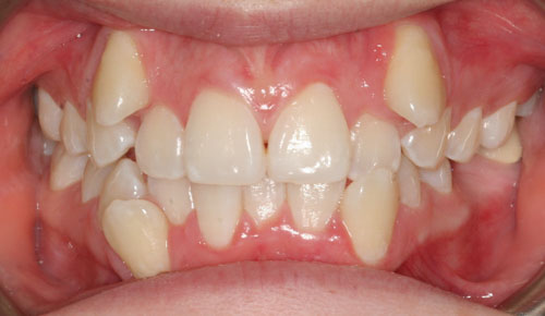 Mức độ phức tạp của răng ảnh hưởng lớn đến thời gian niềng răng