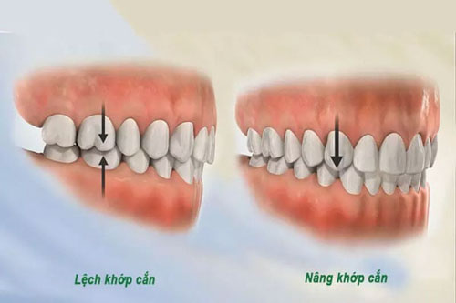 Nâng khớp cắn là kỹ thuật thường dùng trong niềng răng