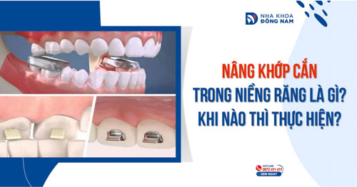 Nâng khớp cắn trong niềng răng là gì? Khi nào thì thực hiện?