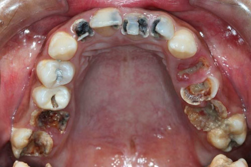 Nguy cơ mất răng vĩnh viễn nếu không sớm điều trị tủy răng