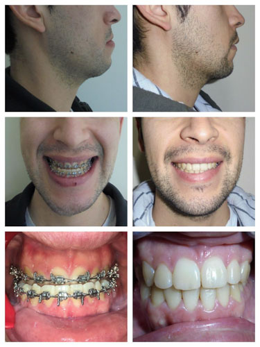 Niềng răng móm không gây ảnh hưởng đến cấu trúc răng