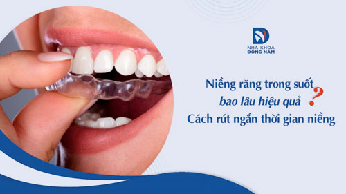 Niềng răng trong suốt bao lâu hiệu quả? Cách rút ngắn thời gian niềng