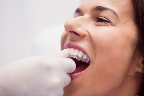 Niềng răng trong suốt giúp khắc phục hiệu quả tình trạng răng khấp khểnh, hô móm
