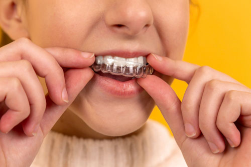Niềng răng trong suốt ở trẻ em sẽ nhanh có kết quả hơn so với người lớn