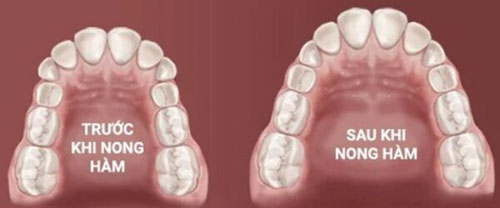 Nong hàm khi niềng răng để khoảng trống cho răng dịch chuyển