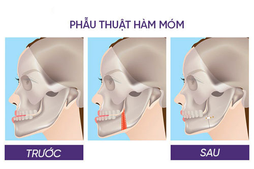 Phẫu thuật hàm móm cần phải chọn địa chỉ đảm bảo uy tín