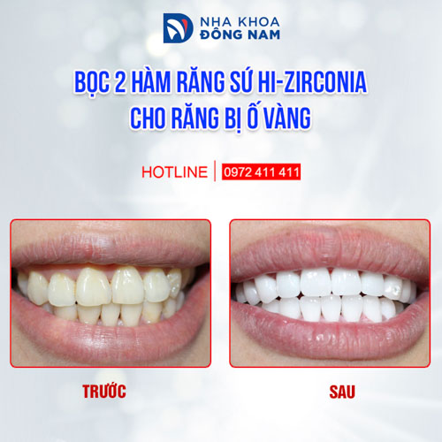 Phục hình bằng răng toàn sứ HI-Zirconia đem lại thẩm mỹ hoàn hảo