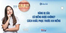 Răng bị sâu có niềng được không? Cách khắc phục trước khi niềng