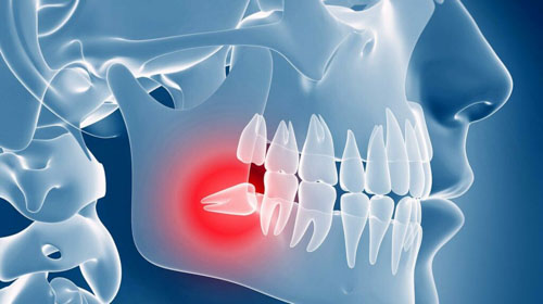 Răng khôn là chiếc răng xuất hiện cuối cùng trên cung hàm khi bước vào độ tuổi trưởng thành