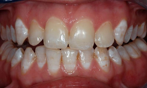 Răng nhiễm fluor là tình trạng khá phổ biến hiện nay