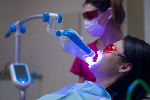 Răng nhiễm fluor rất nhẹ có thể tẩy trắng răng để cải thiện thẩm mỹ