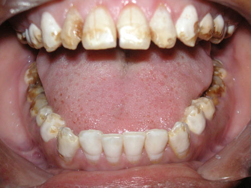 Răng nhiễm màu fluor nặng ảnh hưởng rất lớn đến sức khỏe răng miệng