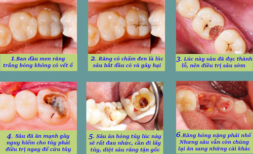 Răng sâu qua các giai đoạn