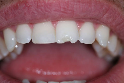 Răng sứ bị mẻ khi ăn nhai bình thường