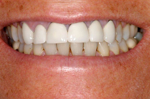 Răng sứ kim loại thường có thẩm mỹ không cao