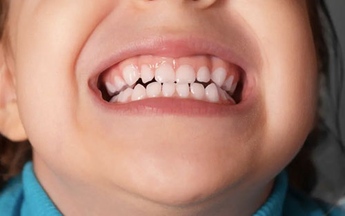 răng sữa mọc lệch ở trẻ