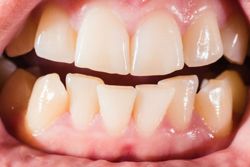 Răng trẻ bị mòn làm tăng nguy cơ răng vĩnh viễn mọc khấp khểnh