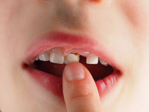 Răng vĩnh viễn mọc lên ở giai đoạn trẻ bắt đầu thay răng sữa