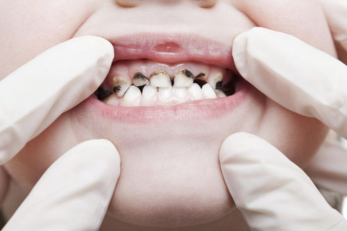 Sâu răng khiến bề mặt răng xuất hiện những lỗ sâu màu nâu, đen