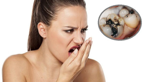 Sâu răng làm hôi miệng là tình trạng rất thường gặp