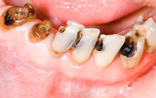 Sâu răng nghiêm trọng có thể gây mất răng vĩnh viễn
