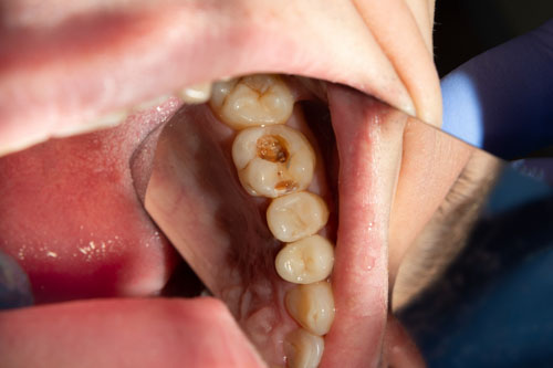 Sâu răng tấn công vào ngà răng hình thành những cơn đau nhức khi ăn thực phẩm nóng lạnh