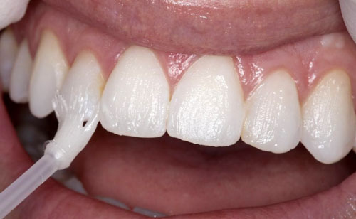 Tái khoáng bổ sung fluor cho răng