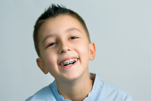Thời gian niềng răng ở trẻ thường ngắn hơn so với người trưởng thành