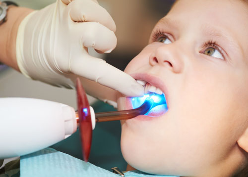Trám răng giúp bảo tồn chiếc răng sữa cho trẻ đến thời điểm thay răng