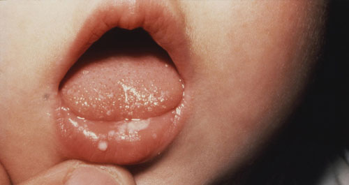 Trẻ có hệ miễn dịch kém rất dễ bị nấm miệng