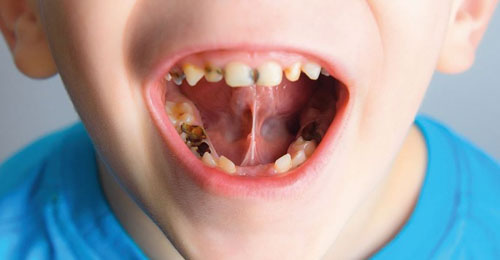 Trẻ em là đối tượng rất dễ bị sâu răng