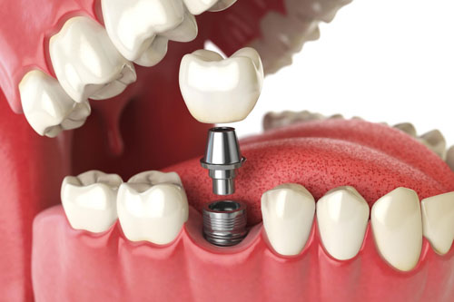 Trồng lại răng mất bằng phương pháp cấy ghép Implant